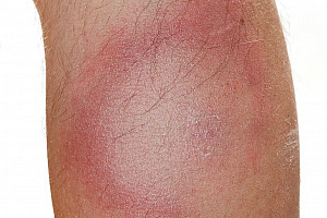 Borreliose: Bakterielle Infektion mit vielen Gesichtern