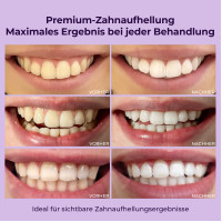 Onlysmile Zahnbleaching Set professionell, 1 st, Hager Pharma GmbH