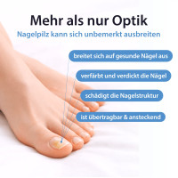 Acetocaustin Nagelpilz Stift gegen Nagelpilz, 4 ml, TheOTCLab B.V.