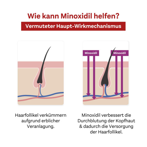 MINOXIDIL DoppelherzPharma 20 mg/ml LsgzAnadH Frau, 3x60 ml, Queisser Pharma GmbH & Co. KG