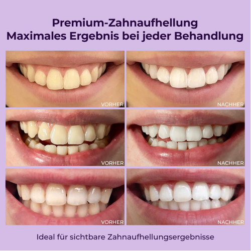OnlySmile Zahnaufhellungsgel, 3x40 ml, Hager Pharma GmbH